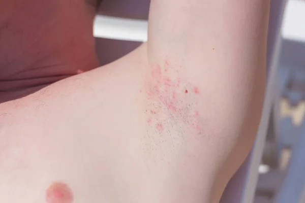 Aisselles Rasées Chez Les Hommes Irritation Rouge Par Rasoir Sur — Photo