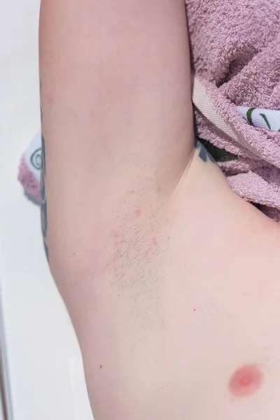 Shaved Armpits Men Red Irritation Razor Skin Guy Lying Sunbed — Stock Photo, Image