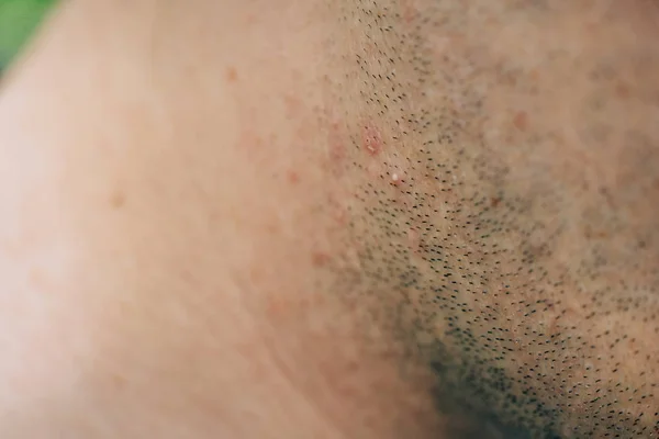 Bristles Guy Face Neck Red Pimples Skin Irritation Skin Shaving — Stock Photo, Image