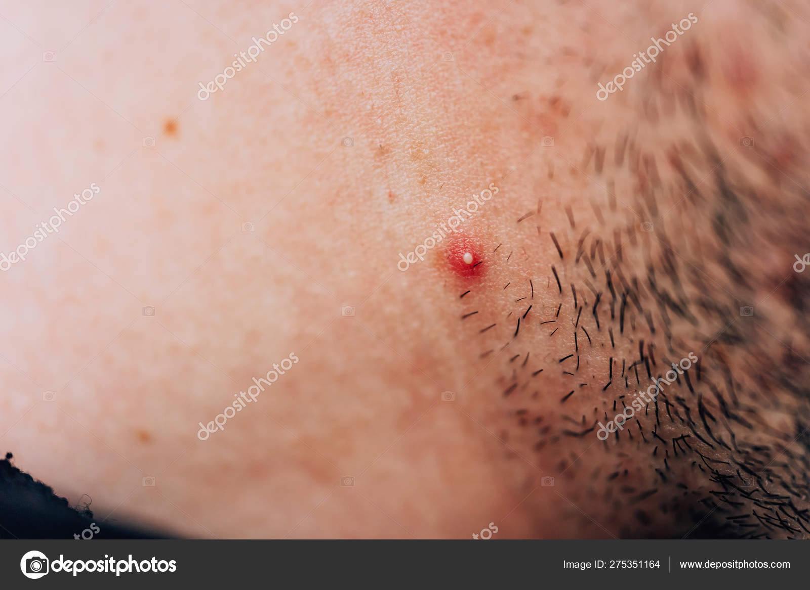 The human body. Shoulder joint Skin texture Strap off the bra. Pimple on  the skin. Inflammatory process. Bruise. Moles on the body. Stock Photo
