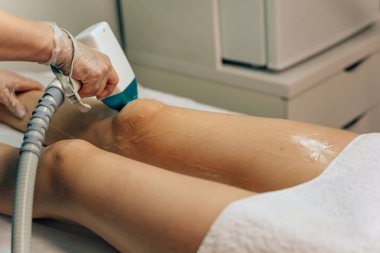 Lazer epilasyon kızlar. Bir kadının bacaklarında epilasyon. Bir lazer ile saç köklerinin tahrip. Radikal bir epilasyon yöntemi. Ofis güzellik lazer radyasyonkullanımı