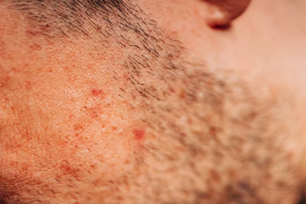 Des Poils Sur Visage Homme Boutons Rouges Inflammation Sur Les — Photo