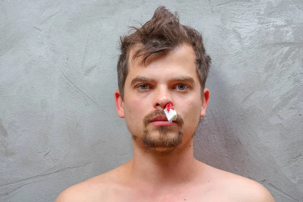 一个年轻人的鼻子流血了男性血压 男人鼻子里的白色餐巾纸停止鼻出血 — 图库照片