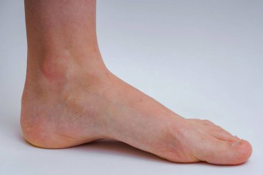 Beyaz arka plan da damarları olan bir kızın bacağı. Genç bir kızın ayağında ki varisler. Bir kadın varis ile Çıplak ayak