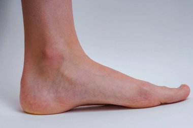 Beyaz arka plan da damarları olan bir kızın bacağı. Genç bir kızın ayağında ki varisler. Bir kadın varis ile Çıplak ayak