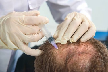 Doktorun ofisindeki kanepedeki adam. Genç bir adam için mezoterapi. Kafasına şırınga yla iğneler. Saç uzatma kel adam. Fotoğraf stüdyosundaki tıp ofisi. Vitamin enjeksiyonları