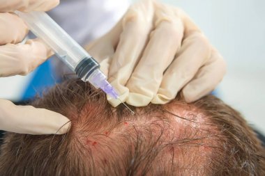 Kafa derisinin mezoterapisi. Erkek tipi kellik. Adamın kafasında kel. Doktor bir adamın kafasına ateş ediyor..