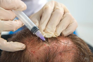 Kafa derisinin mezoterapisi. Erkek tipi kellik. Adamın kafasında kel. Doktor bir adamın kafasına ateş ediyor..