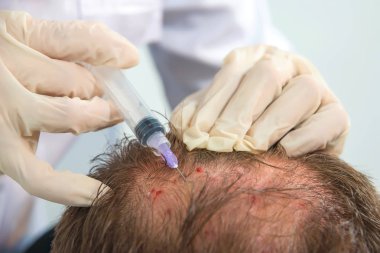 Kafa derisinin mezoterapisi. Erkek tipi kellik. Adamın kafasında kel. Doktor bir adamın kafasına ateş ediyor..
