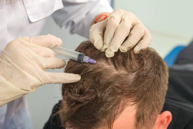 Kafa derisinin mezoterapisi. Erkek tipi kellik. Adamın kafasında kel. Doktor bir adamın kafasına ateş ediyor..