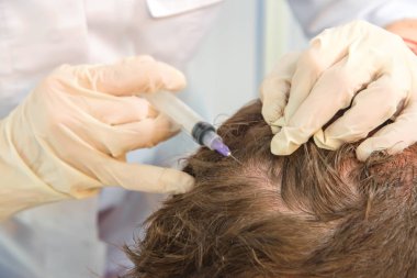 Kafa derisinin mezoterapisi. Erkek tipi kellik. Adamın kafasında kel. Doktor bir adamın kafasına ateş ediyor..