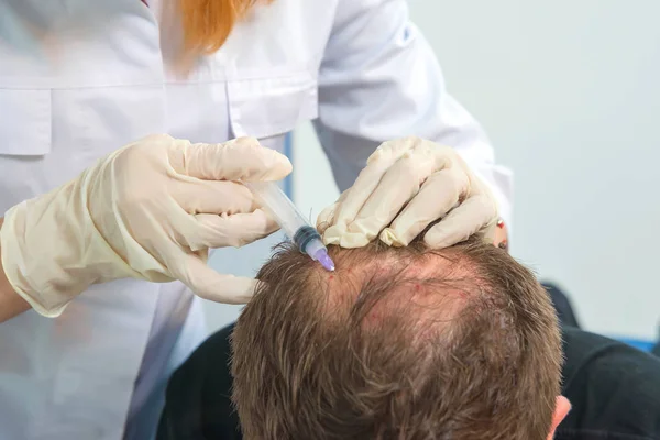 Mesotherapy of the scalp. Male pattern baldness. Bald on the man's head. The doctor makes a shot in the head of a man.