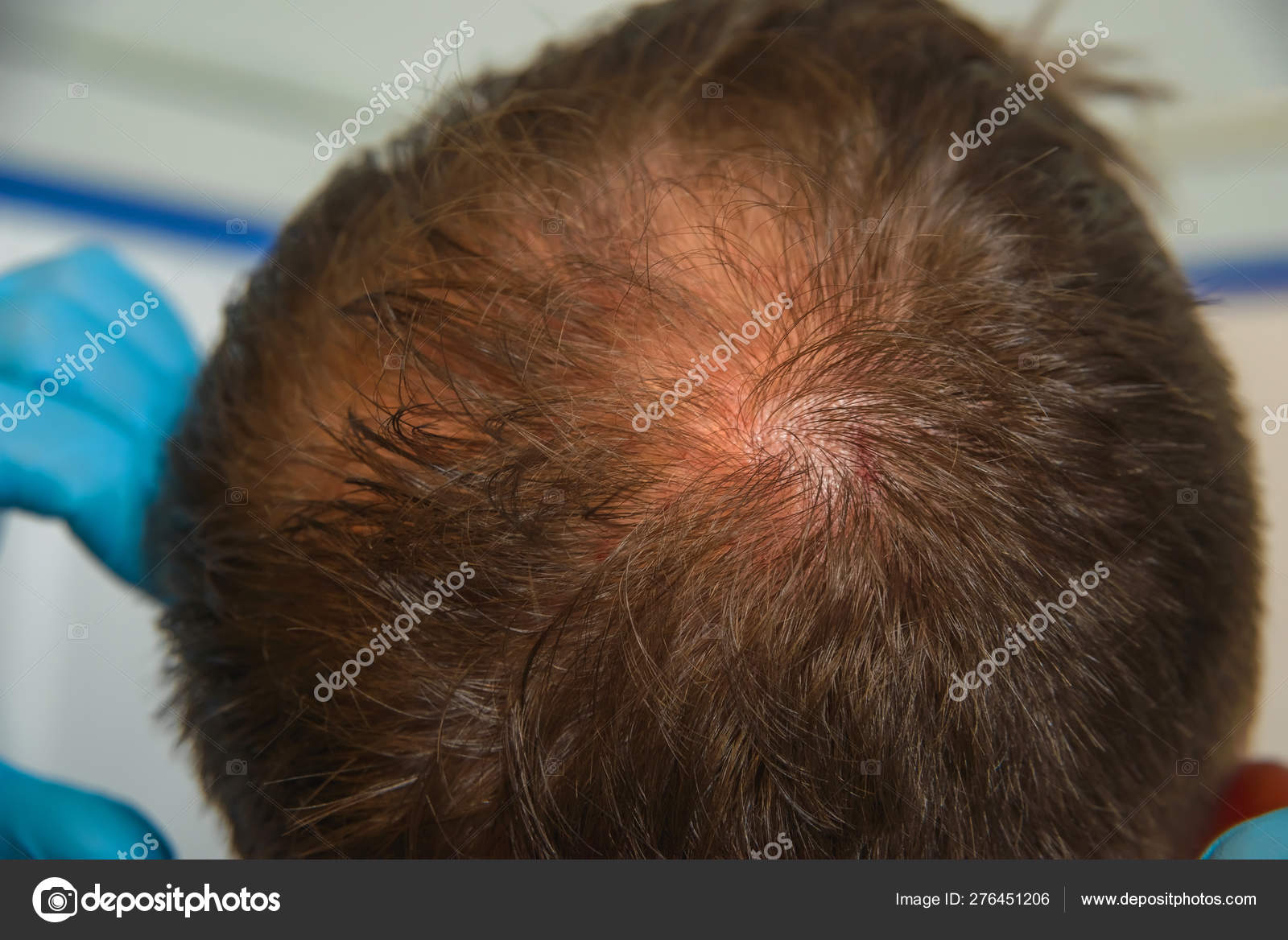 Guy Blue Latex Holding His Head Male Pattern Baldness Mesotherapy Stock  Photo by ©Kinderkz 276451206