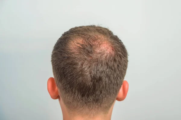 The guy in the medical office. Male pattern baldness. Mesotherapy of the scalp. Bald on the man\'s head.