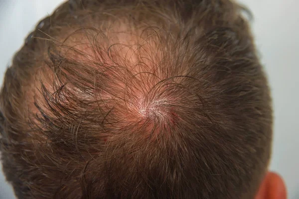 Guy Medical Office Male Pattern Baldness Mesotherapy Scalp Bald Man — Stock Photo, Image
