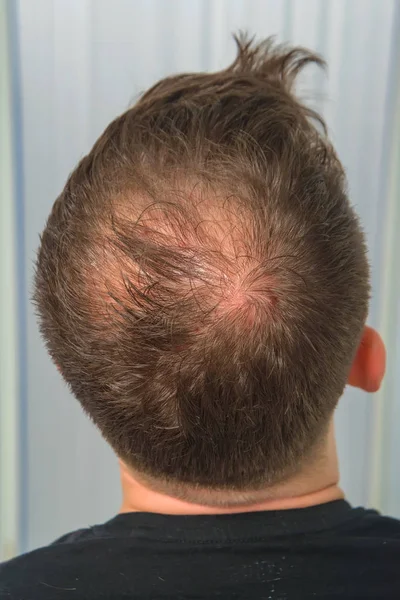 The guy in the medical office. Male pattern baldness. Mesotherapy of the scalp. Bald on the man\'s head.