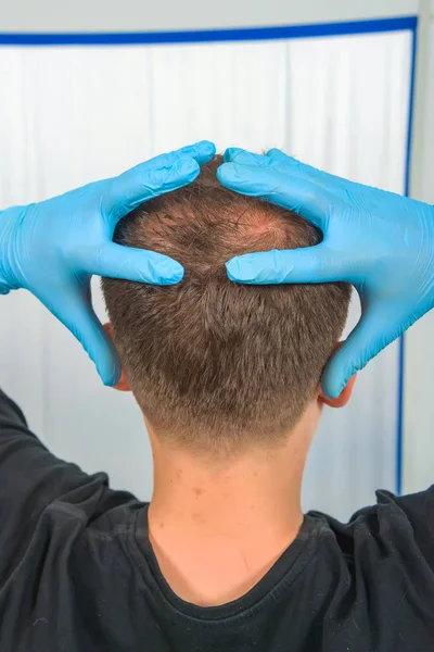 Guy in blue latex holding his head. Male pattern baldness. Mesotherapy of the scalp. Bald on the man\'s head.