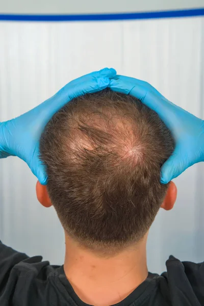 Mavi Lateksli Adam Kafasını Tutuyor Erkek Tipi Kellik Kafa Derisinin — Stok fotoğraf