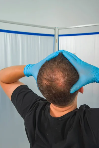 Τύπος Μπλε Λατέξ Κρατάει Κεφάλι Του Αρσενική Φαλάκρα Μοτίβων Μεσοθεραπεία — Φωτογραφία Αρχείου