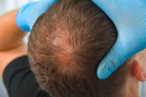 Guy in blue latex holding his head. Male pattern baldness. Mesotherapy of the scalp. Bald on the man's head.