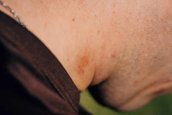 一个年轻人脖子上的Hickey 脖子上的吻痕迹 Hickey Stubble Man Body — 图库照片