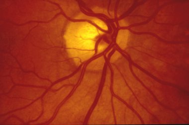 Fundus fotoğraf göz - normal bir insan retinanın arkasında