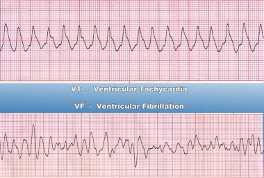 Ventricular Tachycardia -  is fast heart rhythm, that originates in one of the ventricles of the heart. This is a potentially life-threatening arrhythmia because it may lead to ventricular fibrillation, asystole, and sudden death clipart