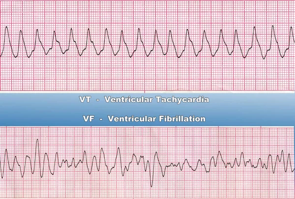 Ventricular Tachycardia -  is fast heart rhythm, that originates in one of the ventricles of the heart. This is a potentially life-threatening arrhythmia because it may lead to ventricular fibrillation, asystole, and sudden death