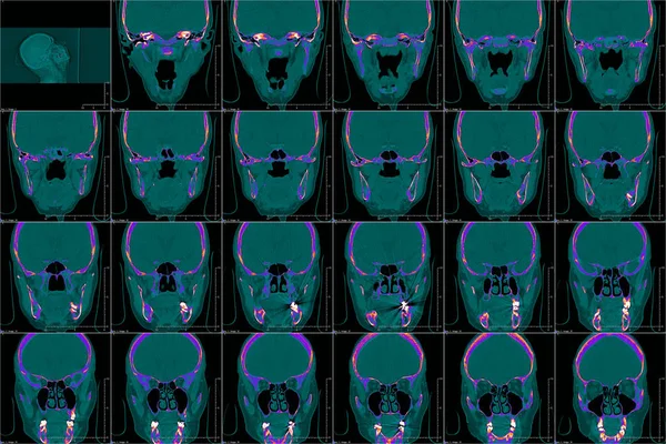 Голова Комп Ютерній Томографії Кольорове Зображення — стокове фото