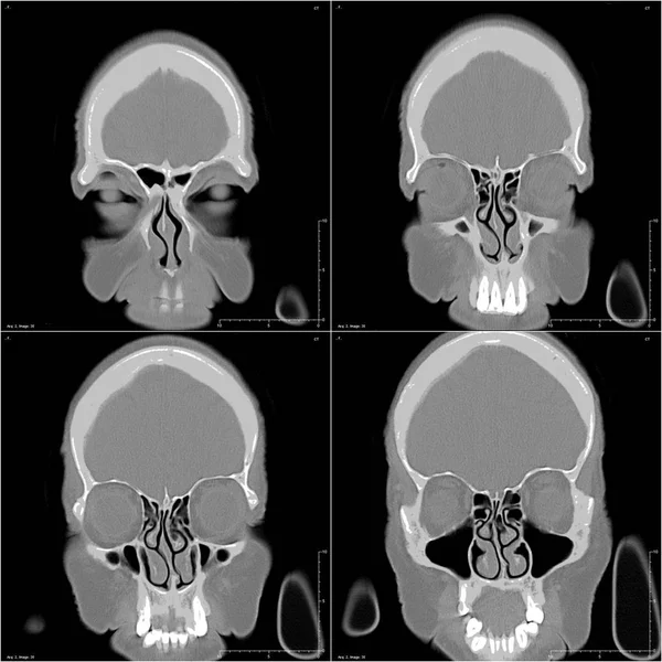 Head Computer Tomography Image — Stock Photo, Image