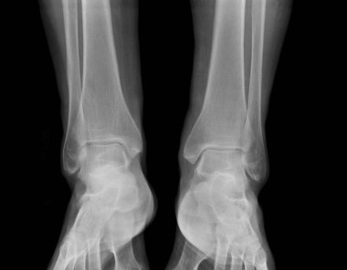 X-Ray tıbbi resim - insan ayakları