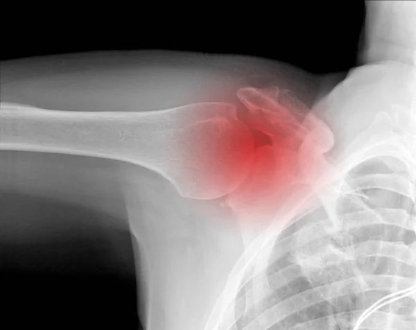 Рентгенівські Малюнок Ключиця Плече Символом Хворобливі Місце — стокове фото