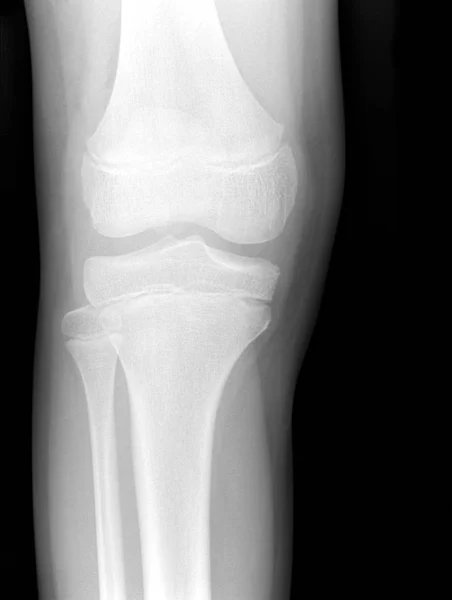 Рентгенівська Медична Картина Людське Коліно — стокове фото