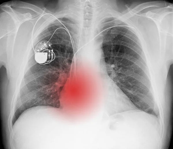 Ray Picture Chest Pacemaker Red Symbol Painful Place — Stock Photo, Image