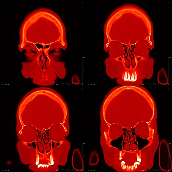 コンピューター断層撮影の頭 画像の色 — ストック写真