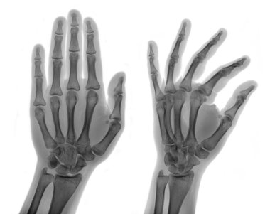 X-ray tıbbi resim - insan avuç içi, izole