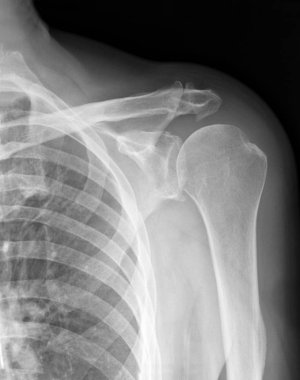 X-Ray tıbbi resim - köprücük kemiği ile akciğer