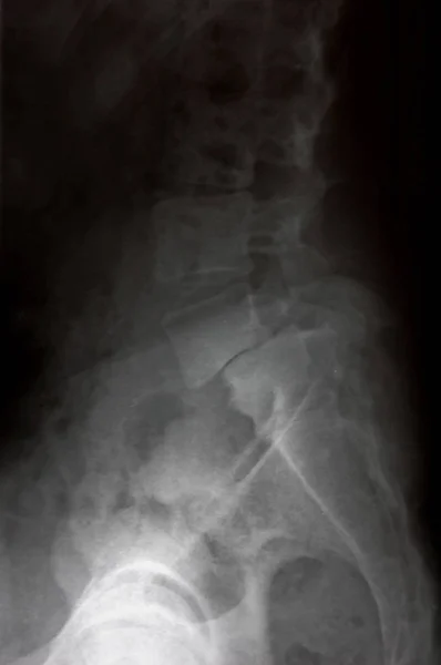 Рентгеновская Медицинская Картина Позвоночник Позвоночник — стоковое фото
