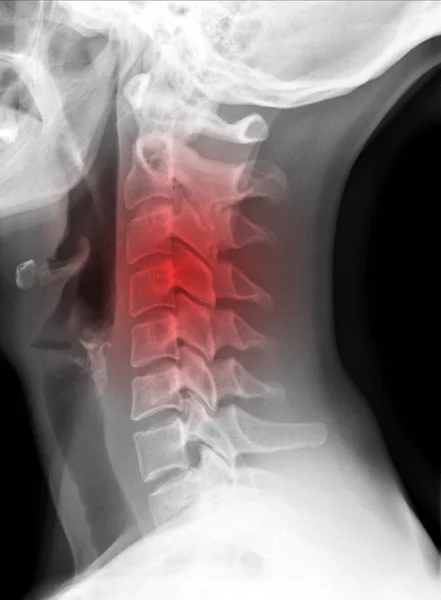 X-ray picture - Cervical spine — Stock Photo, Image