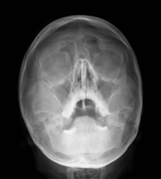 Рентгеновский снимок - Sinus — стоковое фото