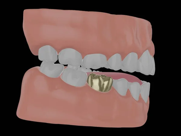 Mandíbula Humana Con Diente Oro Corona Oro Molar Render —  Fotos de Stock