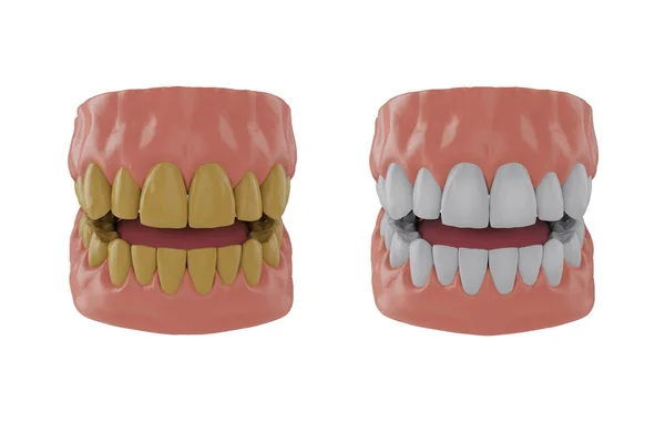 Čelist Žlutými Zuby Čelist Bělenými Zuby Před Bělení Koncepce Vykreslení — Stock fotografie