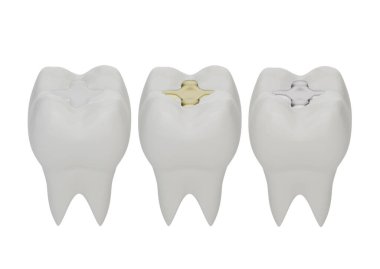 Altın dişler, amalgam ve kompozit dolgu malzemesi. Farklı dolgu tipleri, 3D oluşturma