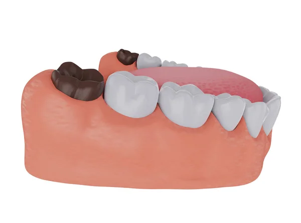 Brown Ovlivnil Zub Moudrosti Zubní Kaz Tmavý Zub Nový Zub — Stock fotografie