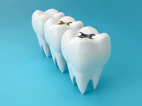 Dientes Con Incrustaciones Oro Amalgama Compuesto Relleno Dental Vista Perspectiva — Foto de Stock