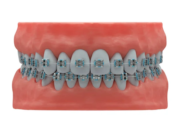 Realistic Human Jaws Healthy Teeth Classic Metal Braces Front View — Stock Photo, Image