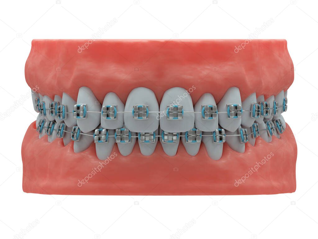 Realistic human jaws with healthy teeth and classic metal braces, front view, 3d render