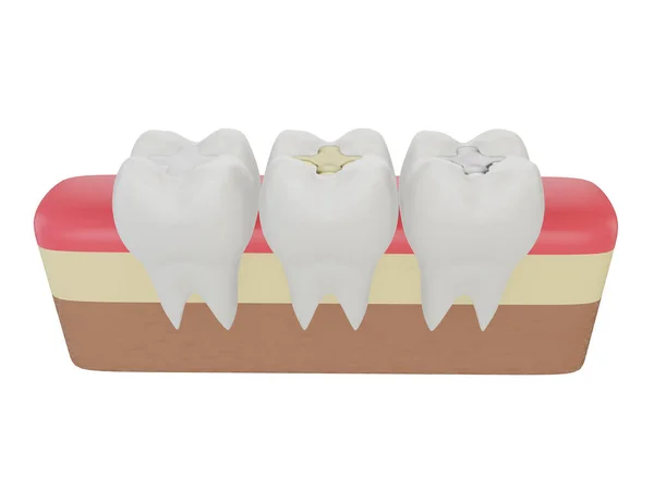 Teeth Gold Amalgam Composite Inlay Dental Filling Three Molar Teeth — Stock Photo, Image