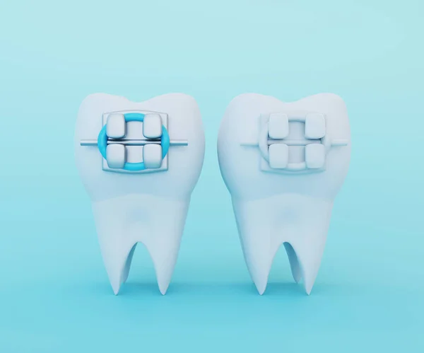 Λευκό Διαυγές Δόντι Μεταλλικά Μπράτσα Και Δόντι Κεραμικά Μπράτσα Σύγκριση — Φωτογραφία Αρχείου