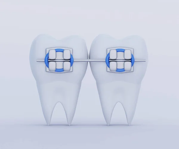 Dwa Zęby Metalowym Aparatem Zęby Pielęgnacja Ortodoncja Symbole Stomatologiczne Renderowanie — Zdjęcie stockowe